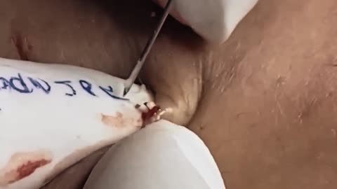 Satisfying and relaxing blackhead removal #3