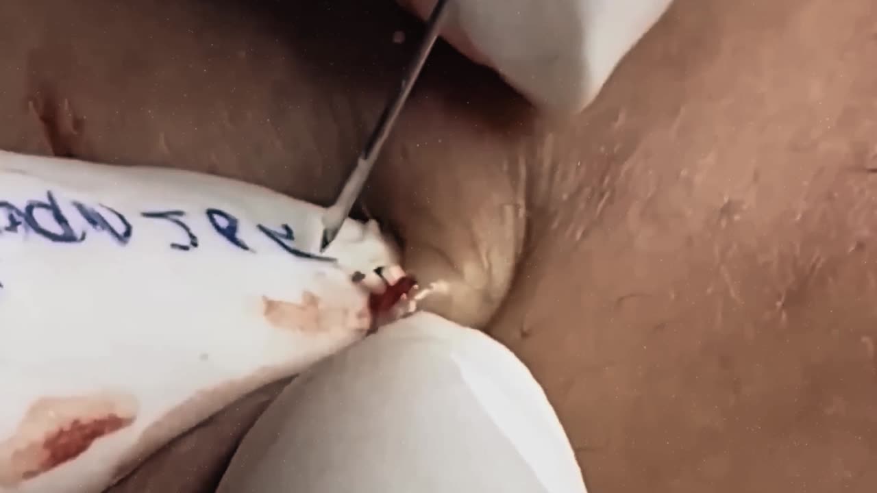 Satisfying and relaxing blackhead removal #3