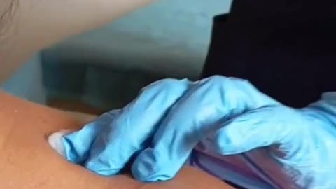 Dry Needling Therapy Explained | CAPAAR Physiotherapy & Rehabilitation