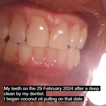 Coconut Oil Pulling Results!
