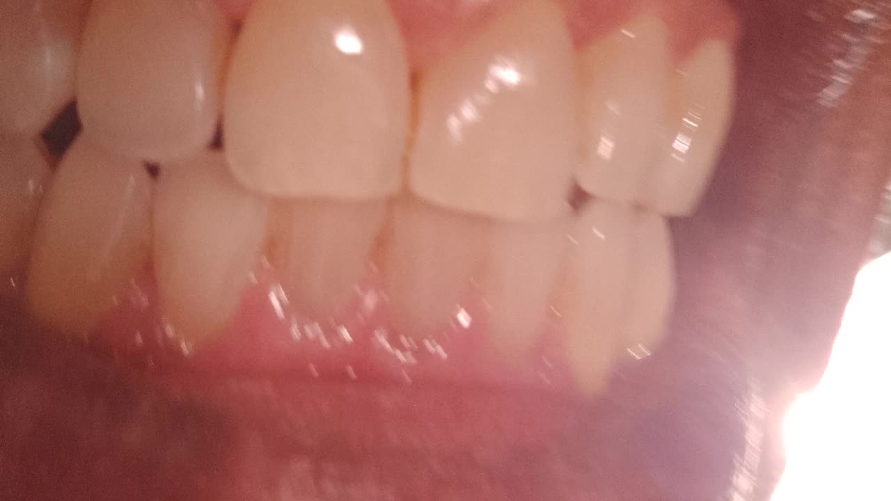 Coconut Oil Pulling Results!