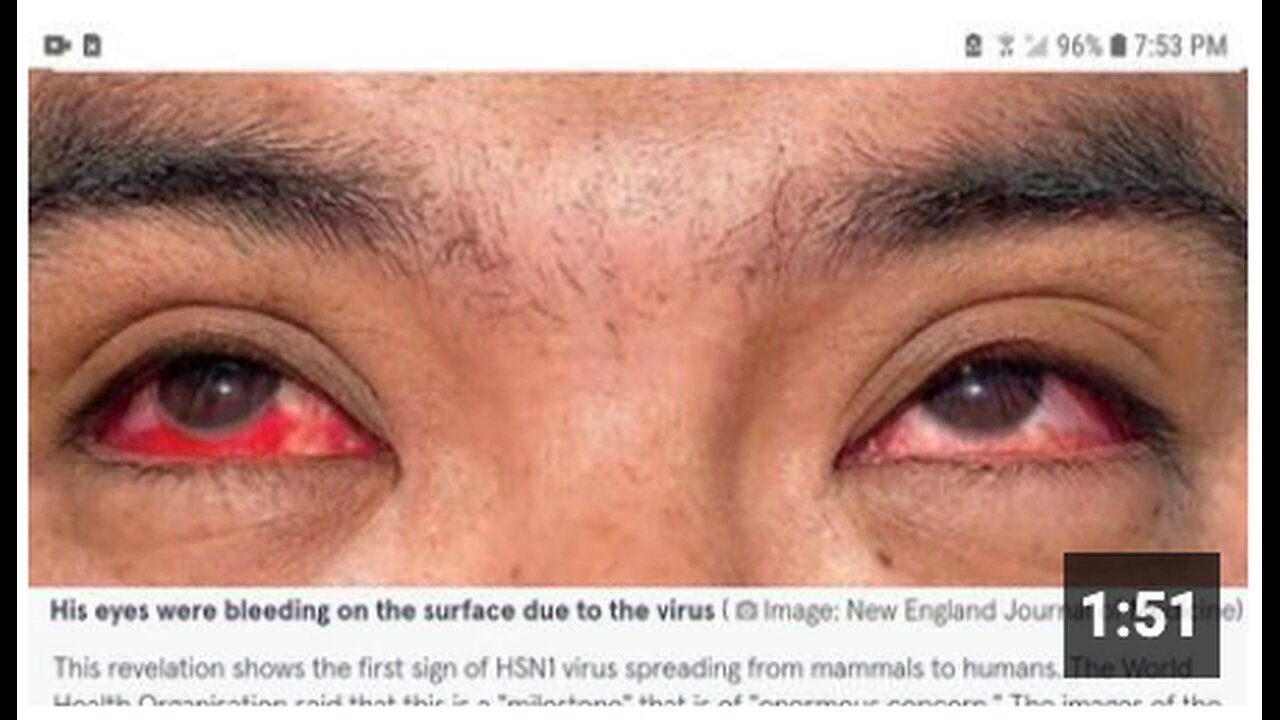 "Bird Flu Causes Bleeding Eyeballs: Graphic Content Warning"