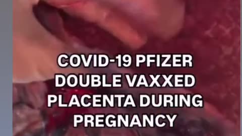 This is not normal, Warning - graphic clip of vaccinated persons placenta