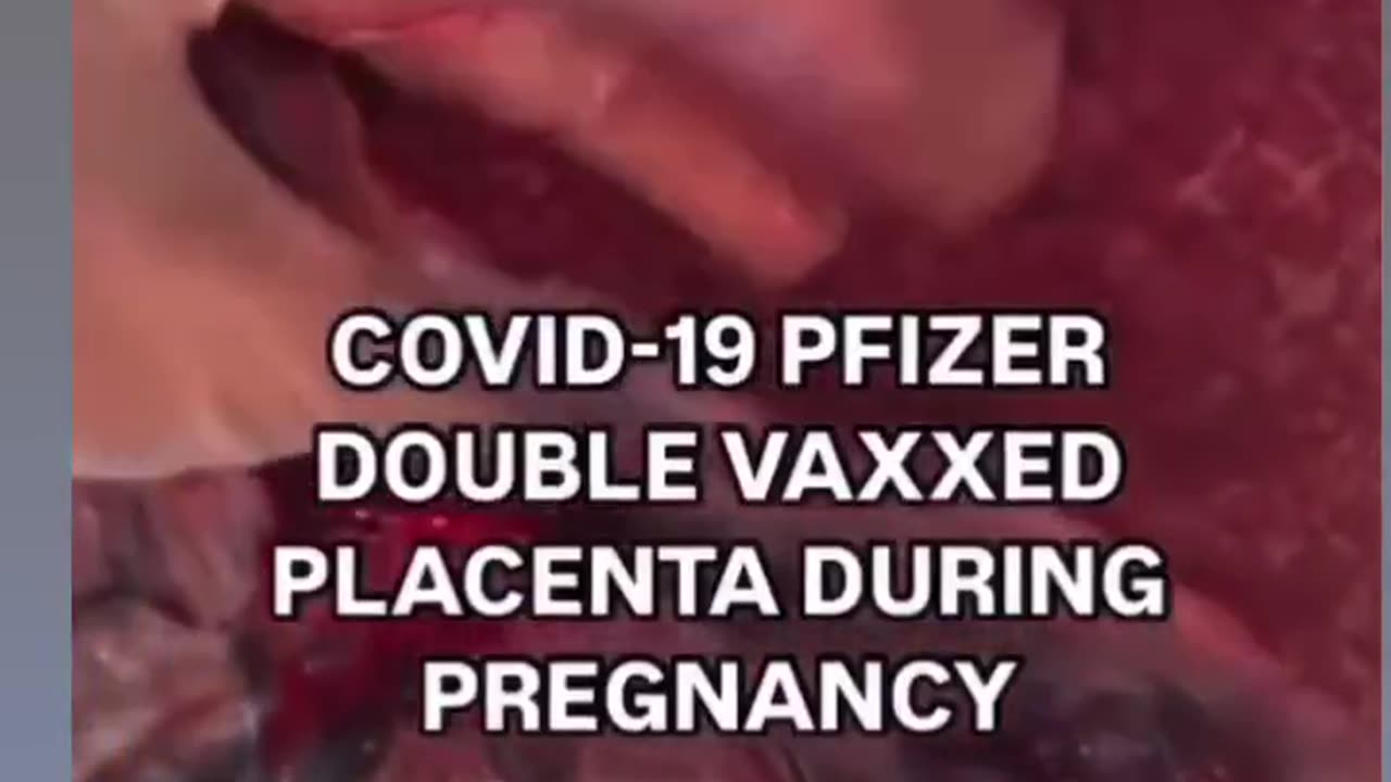 This is not normal, Warning - graphic clip of vaccinated persons placenta