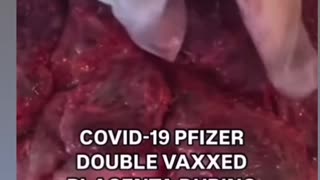 What does a Double Vaccinated Placenta look like compared to Non-Vaccinated Placenta?