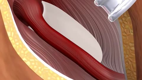 Inguinal Hernia Repair Surgery (3D Animation)