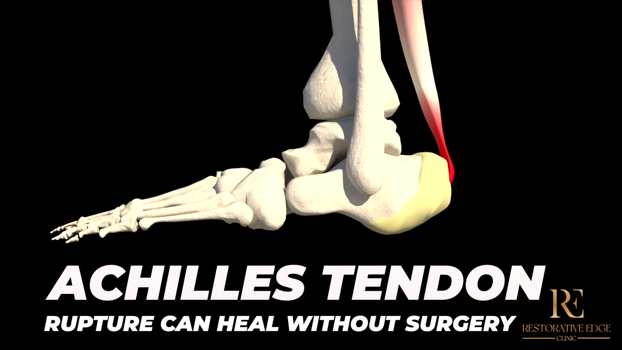 Can You Avoid Achilles Tendon Surgery? Yes — Here’s How