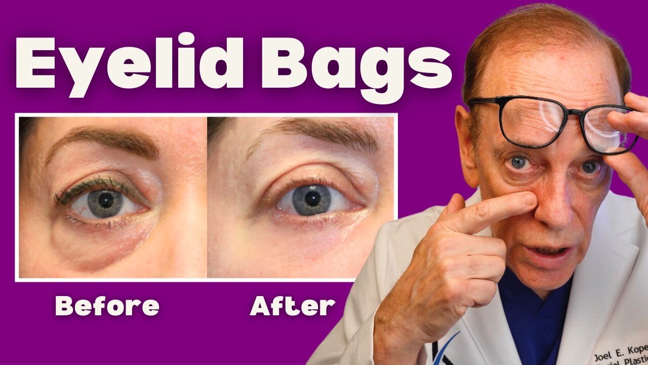 How to Get RID of Under Eye Bags Like A Facial Plastic Surgeon