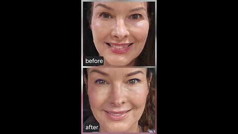Threads for the Gonial angle and temples. Helps lift the aging face
