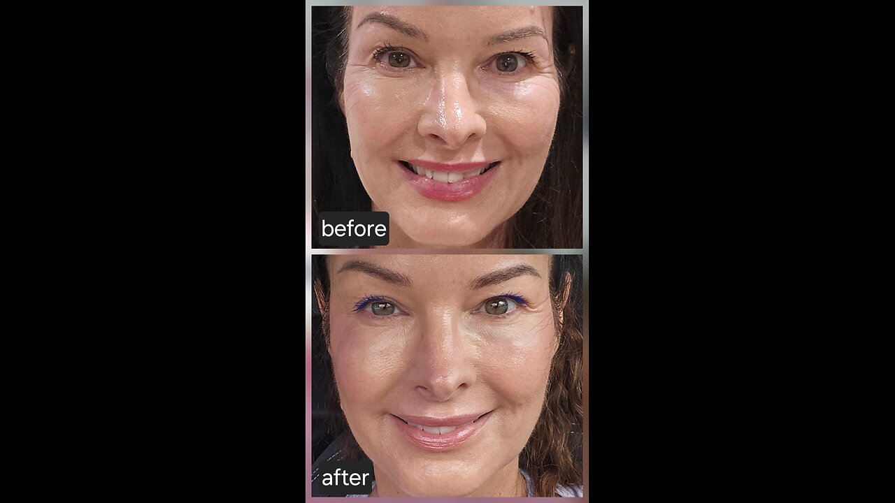 Threads for the Gonial angle and temples. Helps lift the aging face