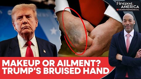 Trump’s Hand Bruise Goes Viral Again, Internet Users Point To Heart Disease | Firstpost America