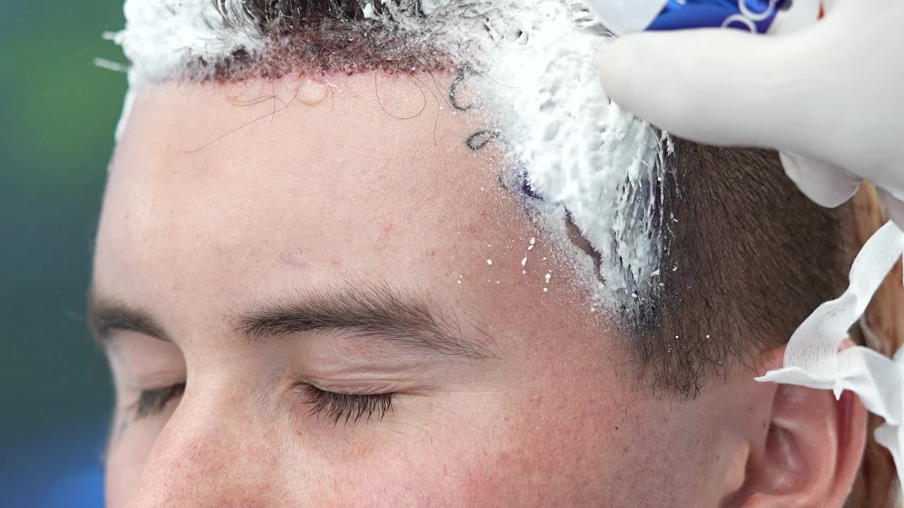 Did you know that you can undergo a hair transplant procedure without needing to shave your head?