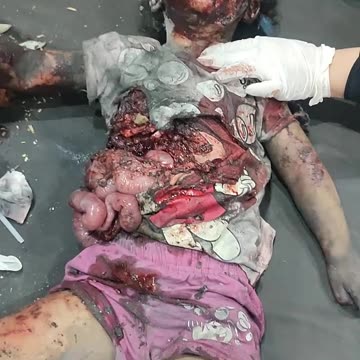 If images of torn and broken children are not enough to stop this madness (Graphic warning)