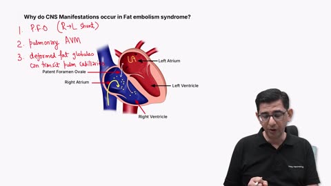 120. Fat Embolism Syndrome