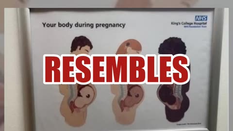 Fact Check: NHS King's College Hospital Did NOT Post An Informational Poster That Shows Pregnant Men