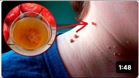 "Natural Home Remedies for Skin Tag Removal"
