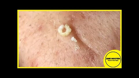 Satisfying Pimple Pops and Deep Blackhead Extractions!