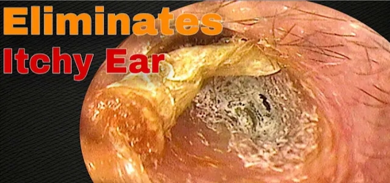The Itching Stopped After Removing Earwax