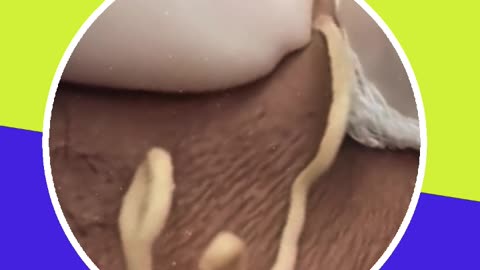 Pimple removal satisfying video (ASMR) #6 #shorts