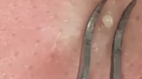 Pimple removal satisfying video (ASMR) #2 #shorts