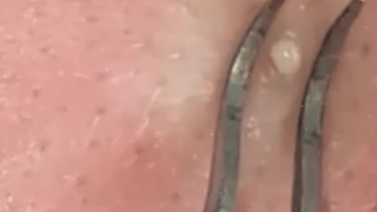 Pimple removal satisfying video (ASMR) #2 #shorts