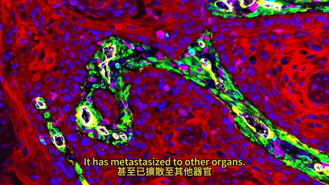免疫治療 逆轉肝癌