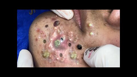 blackhead removal and Pimplepopper Spa relaxation #10115