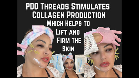 Cheek Enhancement PDO Threads Stimulating Collagen Production, Which Helps to Lift and Firm the Skin