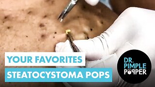 The Ultimate Steatocystomas Compilation of Dr Pimple Popper