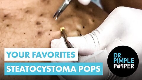 The Ultimate Steatocystomas Compilation of Dr Pimple Popper