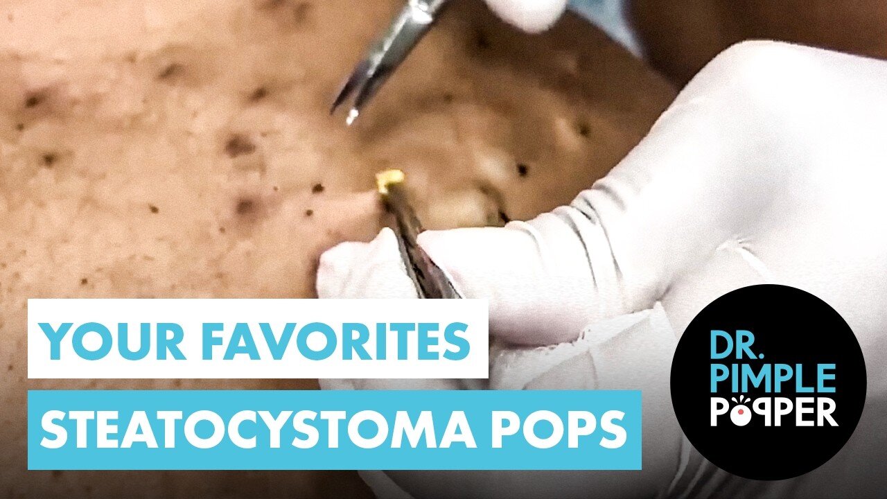 The Ultimate Steatocystomas Compilation of Dr Pimple Popper