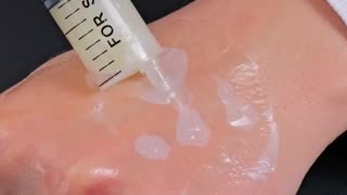 Oddly satisfying pimple pop DIY.hd