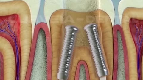 Root Canal Treatment Curveia Dental I RCT