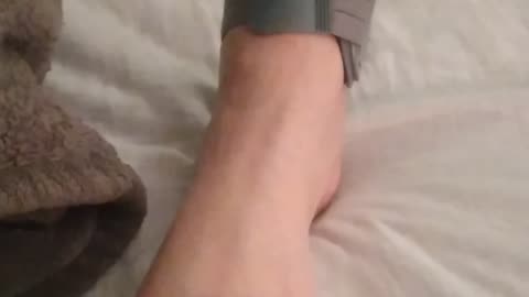 Bunion splint, did it work for you?