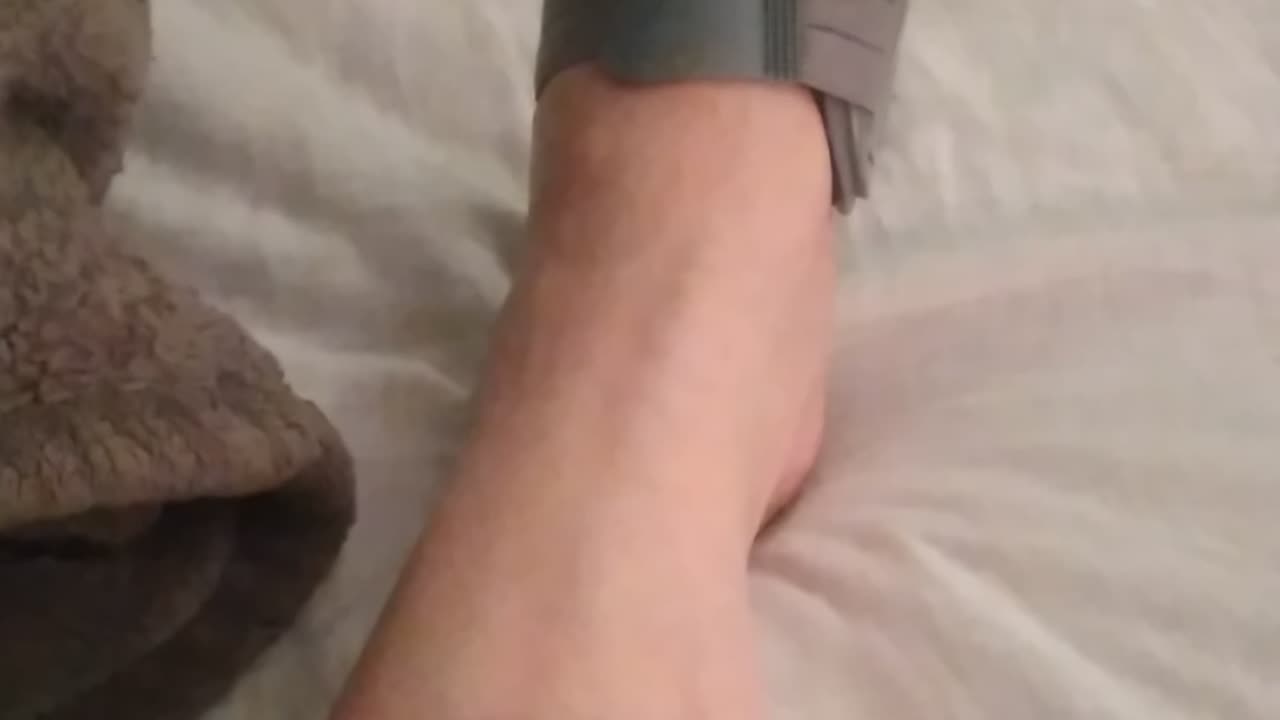 Bunion splint, did it work for you?