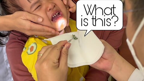 A child PUT candy wrapper into nose | Foreign body removal |