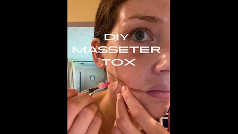 DIY Masseter (JAW) botox!