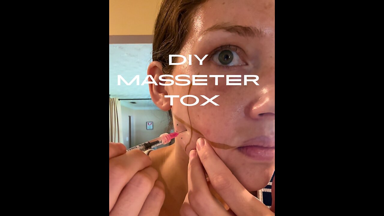 DIY Masseter (JAW) botox!