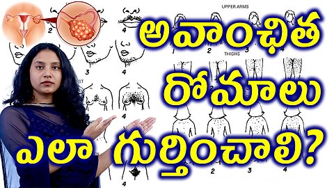 అవాంఛిత రోమాలు ఎలా గుర్తించాలి? Identify Hirsutism Female Unwanted Hair in PCOS in Home Homeopathy