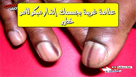 علامة غريبة بجسمك؟ إنذار مبكر لأمر خطير! #صحة #طب #وقاية