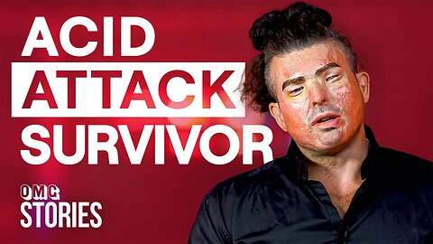 A Pint Of Acid To The Face Changed My Life Forever | OMG Stories