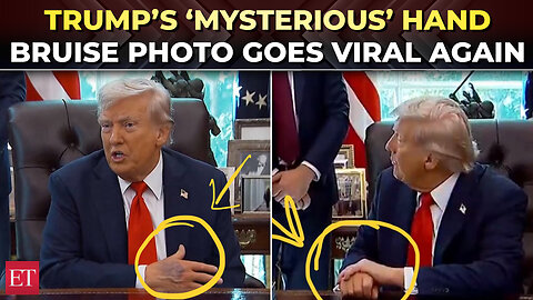 Trump suffering from severe illness? US President's new hand bruise photos ignite health speculation