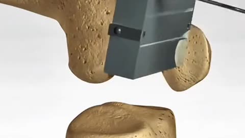 How Knee Transplant Surgery Explained