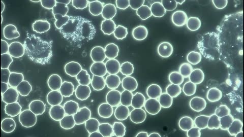 Live Blood Analysis showing a Leaky Gut