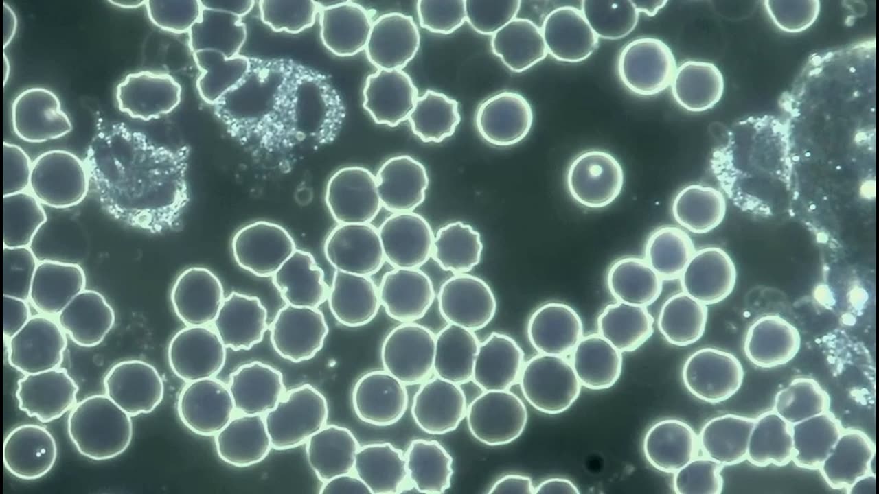 Live Blood Analysis showing a Leaky Gut