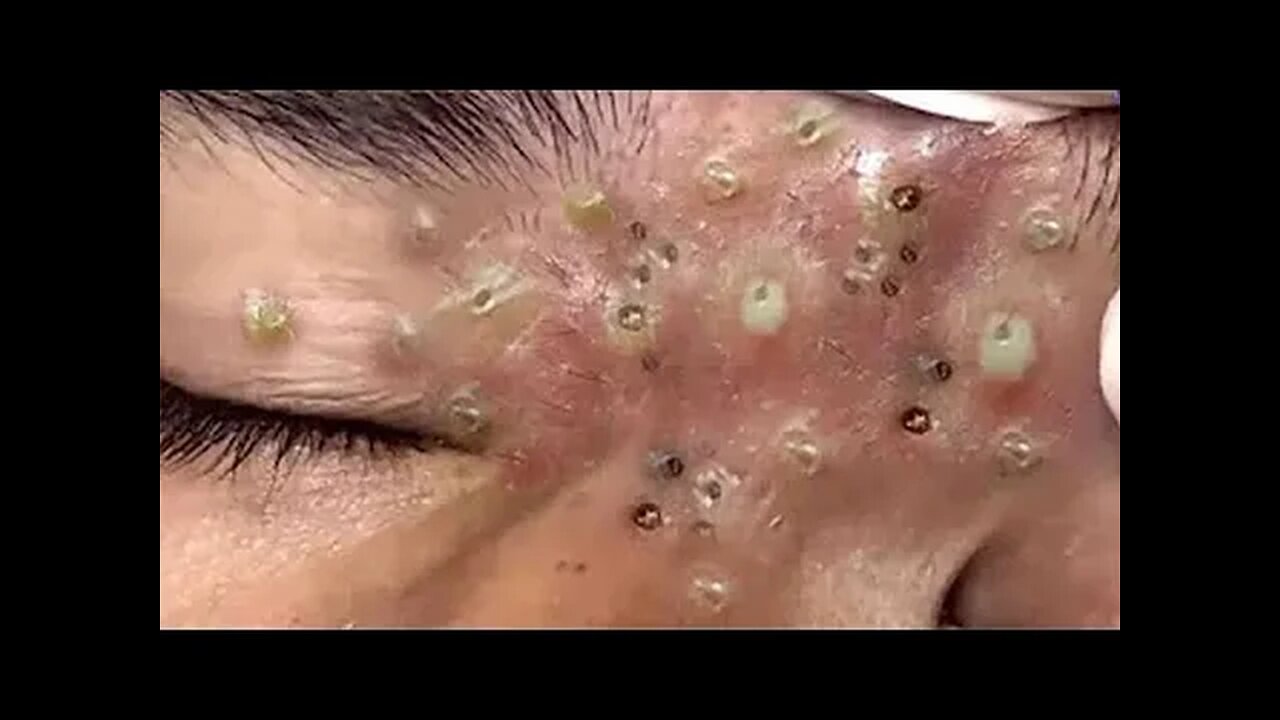 Blackheads Removal & Pimple Popper Cystic Acne Extraction #445