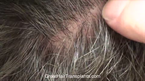 Dr. Brett Bolton – Hair Transplant Scar Compilation Video