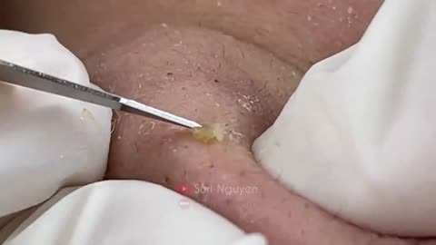 Blackheads Removal & Pimple Popper Cystic Acne Extraction #445