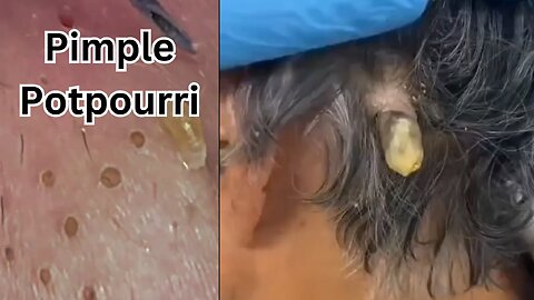 PIMPLE POTPOURRI