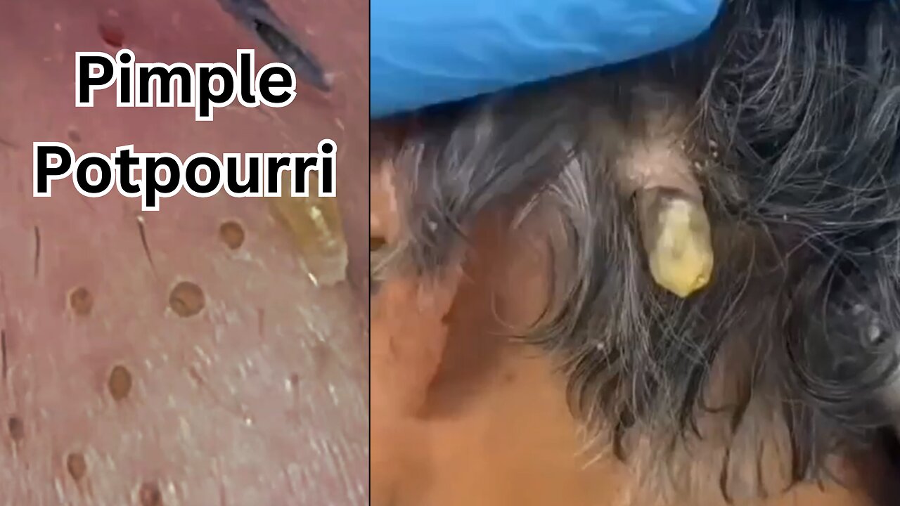 PIMPLE POTPOURRI